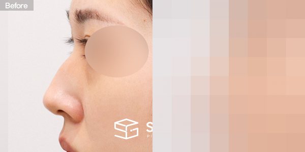 슈가성형외과 첫) 콧대 + 코끝 + 매부리코 전후사진 - 45도 수술 전후 비교