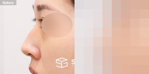 슈가성형외과 첫) 콧대 + 코끝 + 매부리코 전후사진 - 45도 수술 전후 비교