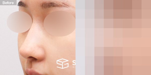 슈가성형외과 재) 재수술 + 매부리코 + 비공 내리기 + 귀 뒤 근막 전후사진 - 정면 수술 전후 비교