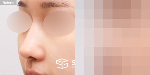 슈가성형외과 재) 재수술 + 매부리코 + 비공 내리기 + 귀 뒤 근막 전후사진 - 정면 수술 전후 비교