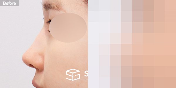슈가성형외과 재) 재수술 + 매부리코 + 비공 내리기 + 귀 뒤 근막 전후사진 - 45도 수술 전후 비교