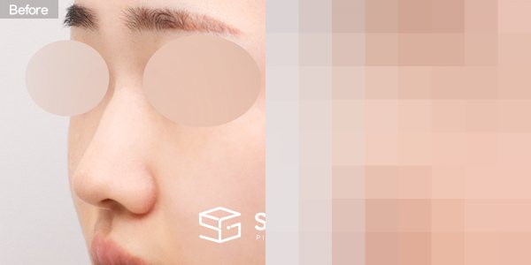 슈가성형외과 첫) 콧대 + 코끝 + 매부리코 + 복코 + 절골 + 귀연골 전후사진 - 정면 수술 전후 비교