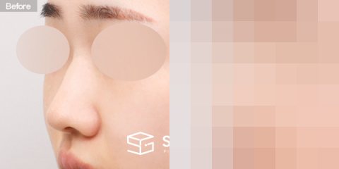 슈가성형외과 첫) 콧대 + 코끝 + 매부리코 + 복코 + 절골 + 귀연골 전후사진 - 정면 수술 전후 비교