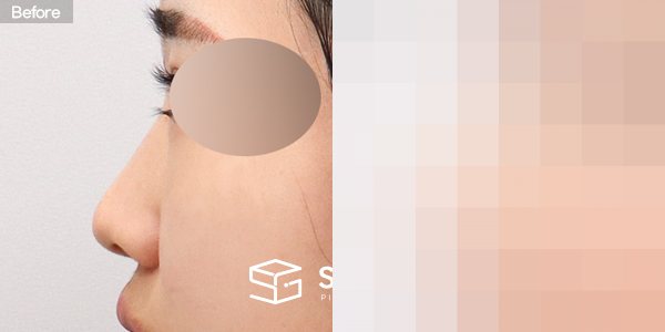 슈가성형외과 첫) 콧대 + 코끝 + 매부리코 + 복코 + 절골 + 귀연골 전후사진 - 45도 수술 전후 비교