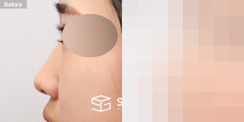 슈가성형외과 첫) 콧대 + 코끝 + 매부리코 + 복코 + 절골 + 귀연골 전후사진 - 45도 수술 전후 비교