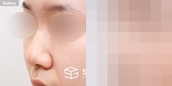 슈가성형외과 첫) 콧대 + 코끝 + 복코 + 비중격 + 귀연골 전후사진 - 정면 수술 전후 비교