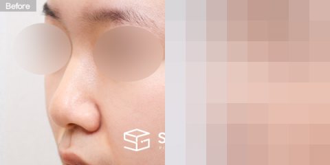 슈가성형외과 첫) 콧대 + 코끝 + 복코 + 비중격 + 귀연골 전후사진 - 정면 수술 전후 비교