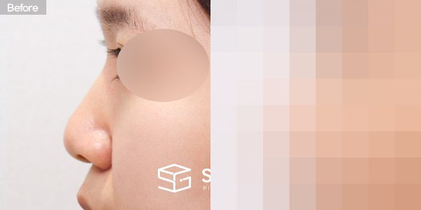 슈가성형외과 첫) 콧대 + 코끝 + 복코 + 비중격 + 귀연골 전후사진 - 45도 수술 전후 비교