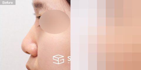 슈가성형외과 첫) 콧대 + 코끝 + 복코 + 비중격 + 귀연골 전후사진 - 45도 수술 전후 비교