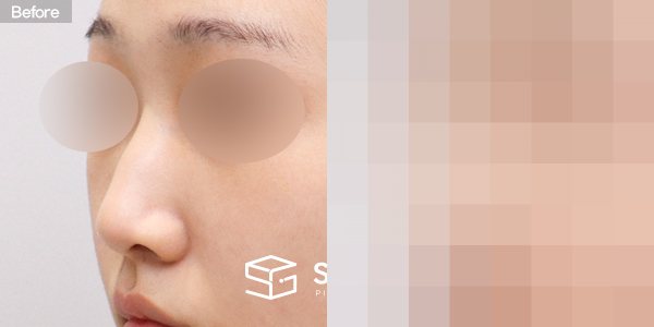 슈가성형외과 첫) 콧대 + 코끝 + 매부리코 + 무보형물 코성형 + 콧볼 축소 + 비중격 + 귀연골 전후사진 - 정면 수술 전후 비교