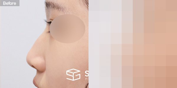 슈가성형외과 첫) 콧대 + 코끝 + 매부리코 + 무보형물 코성형 + 콧볼 축소 + 비중격 + 귀연골 전후사진 - 45도 수술 전후 비교