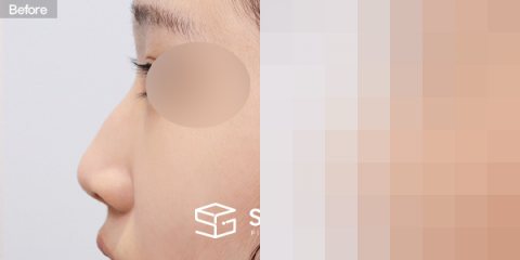 슈가성형외과 첫) 콧대 + 코끝 + 매부리코 + 무보형물 코성형 + 콧볼 축소 + 비중격 + 귀연골 전후사진 - 45도 수술 전후 비교