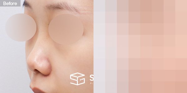 슈가성형외과 첫) 콧대 + 코끝 + 비중격 + 귀연골 전후사진 - 정면 수술 전후 비교