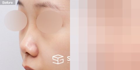 슈가성형외과 첫) 콧대 + 코끝 + 비중격 + 귀연골 전후사진 - 정면 수술 전후 비교