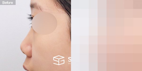 슈가성형외과 첫) 콧대 + 코끝 + 비중격 + 귀연골 전후사진 - 45도 수술 전후 비교