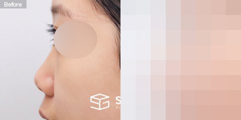 슈가성형외과 첫) 콧대 + 코끝 + 비중격 + 귀연골 전후사진 - 45도 수술 전후 비교