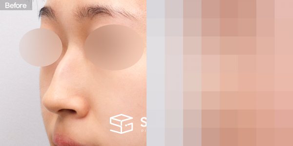 슈가성형외과 첫) 콧대 + 코끝 + 매부리코 + 휜코 전후사진 - 정면 수술 전후 비교
