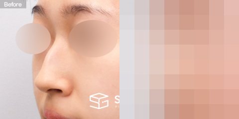 슈가성형외과 첫) 콧대 + 코끝 + 매부리코 + 휜코 전후사진 - 정면 수술 전후 비교