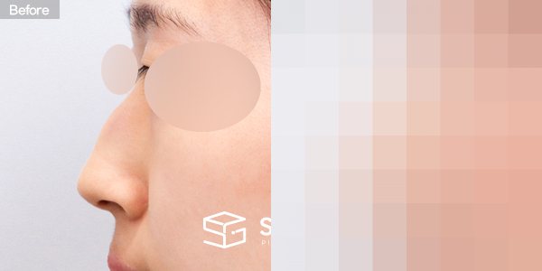 슈가성형외과 첫) 콧대 + 코끝 + 매부리코 + 휜코 전후사진 - 45도 수술 전후 비교