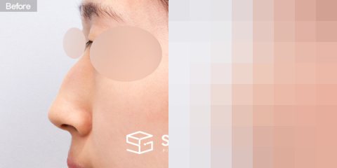 슈가성형외과 첫) 콧대 + 코끝 + 매부리코 + 휜코 전후사진 - 45도 수술 전후 비교