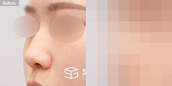 슈가성형외과 첫) 코끝 + 매부리코 + 휜코 + 절골 + 귀연골 + 귀 뒤 근막 전후사진 - 정면 수술 전후 비교