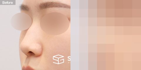 슈가성형외과 첫) 코끝 + 매부리코 + 휜코 + 절골 + 귀연골 + 귀 뒤 근막 전후사진 - 정면 수술 전후 비교