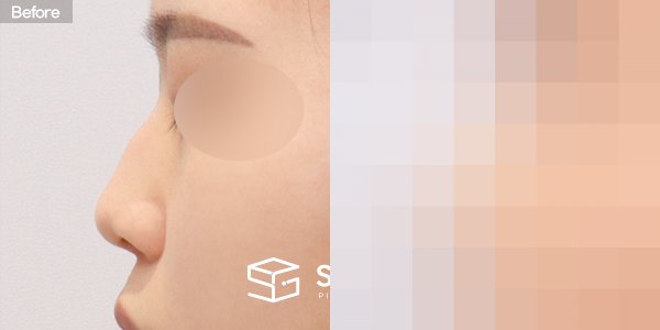 슈가성형외과 첫) 코끝 + 매부리코 + 휜코 + 절골 + 귀연골 + 귀 뒤 근막 전후사진 - 45도 수술 전후 비교