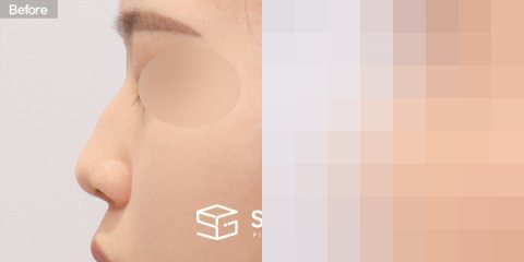 슈가성형외과 첫) 코끝 + 매부리코 + 휜코 + 절골 + 귀연골 + 귀 뒤 근막 전후사진 - 45도 수술 전후 비교
