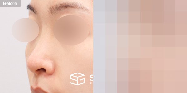 슈가성형외과 첫) 콧대 + 코끝 + 복코 + 비공 내리기 + 절골 + 귀연골 전후사진 - 정면 수술 전후 비교