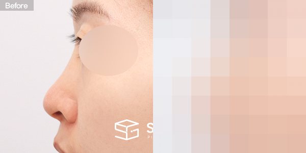 슈가성형외과 첫) 콧대 + 코끝 + 복코 + 비공 내리기 + 절골 + 귀연골 전후사진 - 45도 수술 전후 비교