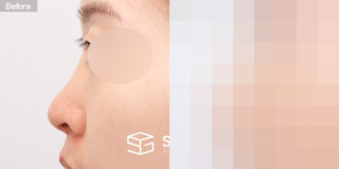 슈가성형외과 첫) 콧대 + 코끝 + 복코 + 비공 내리기 + 절골 + 귀연골 전후사진 - 45도 수술 전후 비교
