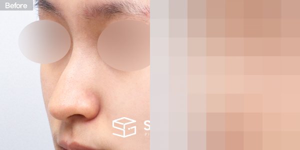 슈가성형외과 첫) 코끝 + 매부리코 + 복코 + 휜코 + 귀연골 전후사진 - 정면 수술 전후 비교