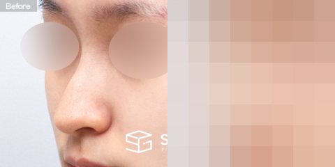 슈가성형외과 첫) 코끝 + 매부리코 + 복코 + 휜코 + 귀연골 전후사진 - 정면 수술 전후 비교