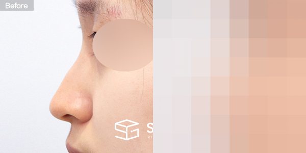 슈가성형외과 첫) 코끝 + 매부리코 + 복코 + 휜코 + 귀연골 전후사진 - 45도 수술 전후 비교