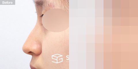슈가성형외과 첫) 코끝 + 매부리코 + 복코 + 휜코 + 귀연골 전후사진 - 45도 수술 전후 비교