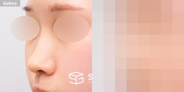 슈가성형외과 첫) 콧대 + 코끝 + 매부리코 전후사진 - 정면 수술 전후 비교
