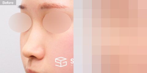 슈가성형외과 첫) 콧대 + 코끝 + 매부리코 전후사진 - 정면 수술 전후 비교