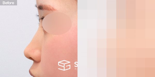 슈가성형외과 첫) 콧대 + 코끝 + 매부리코 전후사진 - 45도 수술 전후 비교