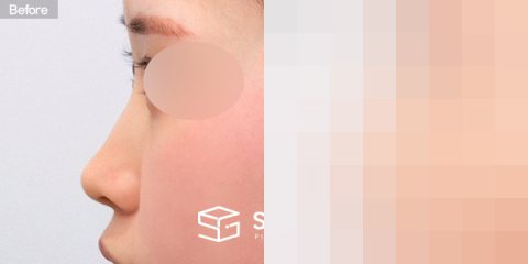슈가성형외과 첫) 콧대 + 코끝 + 매부리코 전후사진 - 45도 수술 전후 비교