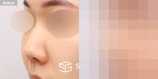슈가성형외과 첫) 콧대 + 코끝 + 매부리코 + 짧은코 + 비중격 + 귀연골 전후사진 - 정면 수술 전후 비교