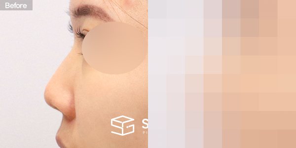 슈가성형외과 첫) 콧대 + 코끝 + 매부리코 + 짧은코 + 비중격 + 귀연골 전후사진 - 45도 수술 전후 비교