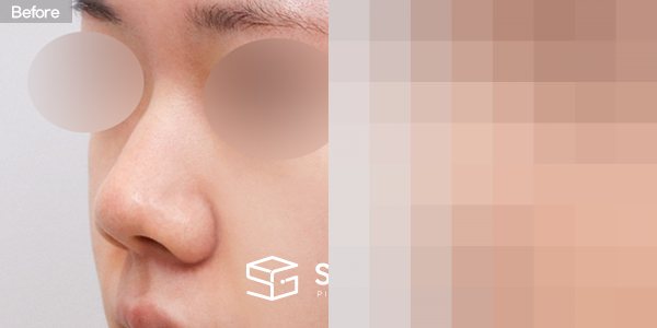 슈가성형외과 첫) 콧대 + 코끝 + 매부리코 + 복코 + 콧볼축소 + 귀연골 전후사진 - 정면 수술 전후 비교