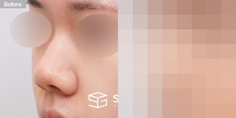 슈가성형외과 첫) 콧대 + 코끝 + 매부리코 + 복코 + 콧볼축소 + 귀연골 전후사진 - 정면 수술 전후 비교