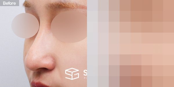 슈가성형외과 재) 재수술 + 복코 + 비중격 + 귀연골 전후사진 - 정면 수술 전후 비교