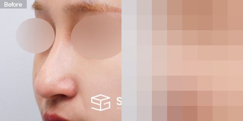 슈가성형외과 재) 재수술 + 복코 + 비중격 + 귀연골 전후사진 - 정면 수술 전후 비교