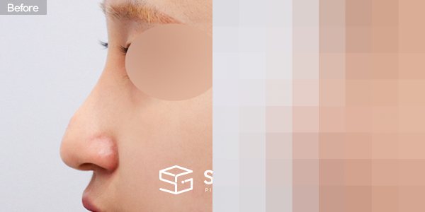 슈가성형외과 재) 재수술 + 복코 + 비중격 + 귀연골 전후사진 - 45도 수술 전후 비교