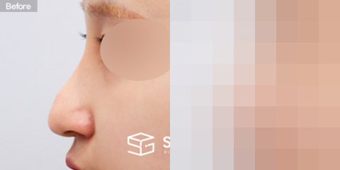 슈가성형외과 재) 재수술 + 복코 + 비중격 + 귀연골 전후사진 - 45도 수술 전후 비교