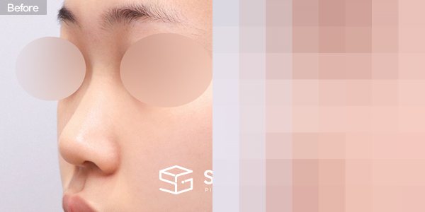슈가성형외과 첫) 콧대 + 코끝 + 매부리코 + 복코 + 절골 + 비중격 + 귀연골 전후사진 - 정면 수술 전후 비교