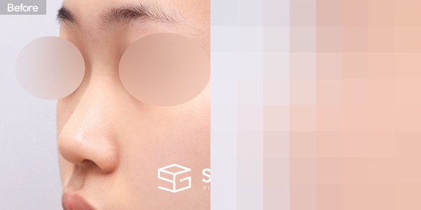 슈가성형외과 첫) 콧대 + 코끝 + 매부리코 + 복코 + 절골 + 비중격 + 귀연골 전후사진 - 45도 수술 전후 비교