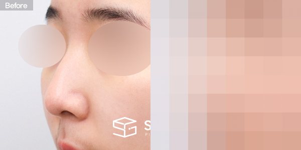 슈가성형외과 첫) 코끝 + 매부리코 + 무보형물 코성형 + 절골 + 귀연골 전후사진 - 정면 수술 전후 비교